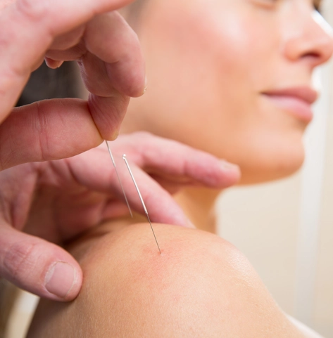 A patient receiving dry needling on their shoulder.